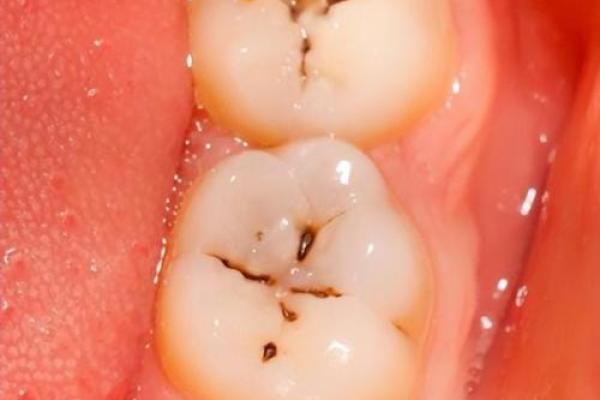 梦见拔牙是什么意思(梦见拔牙是什么意思预兆)