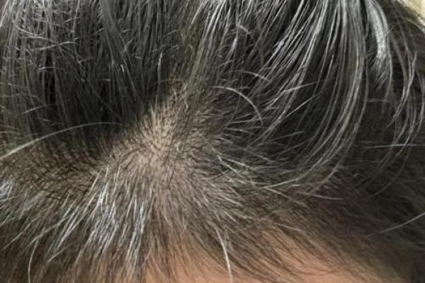 梦见自己头发秃了一大片是什么意思(女人梦见头发掉了秃了一大片)